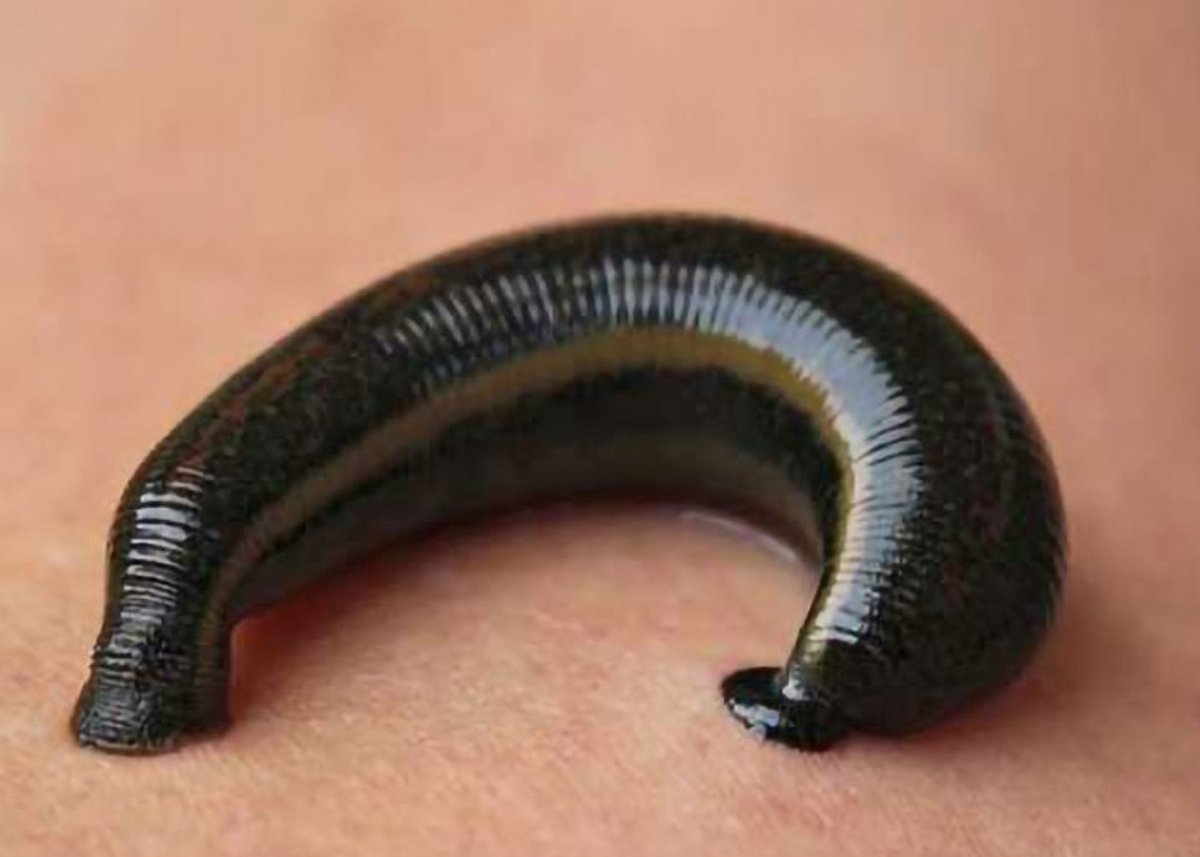 Hirudoterapi (Sülük)