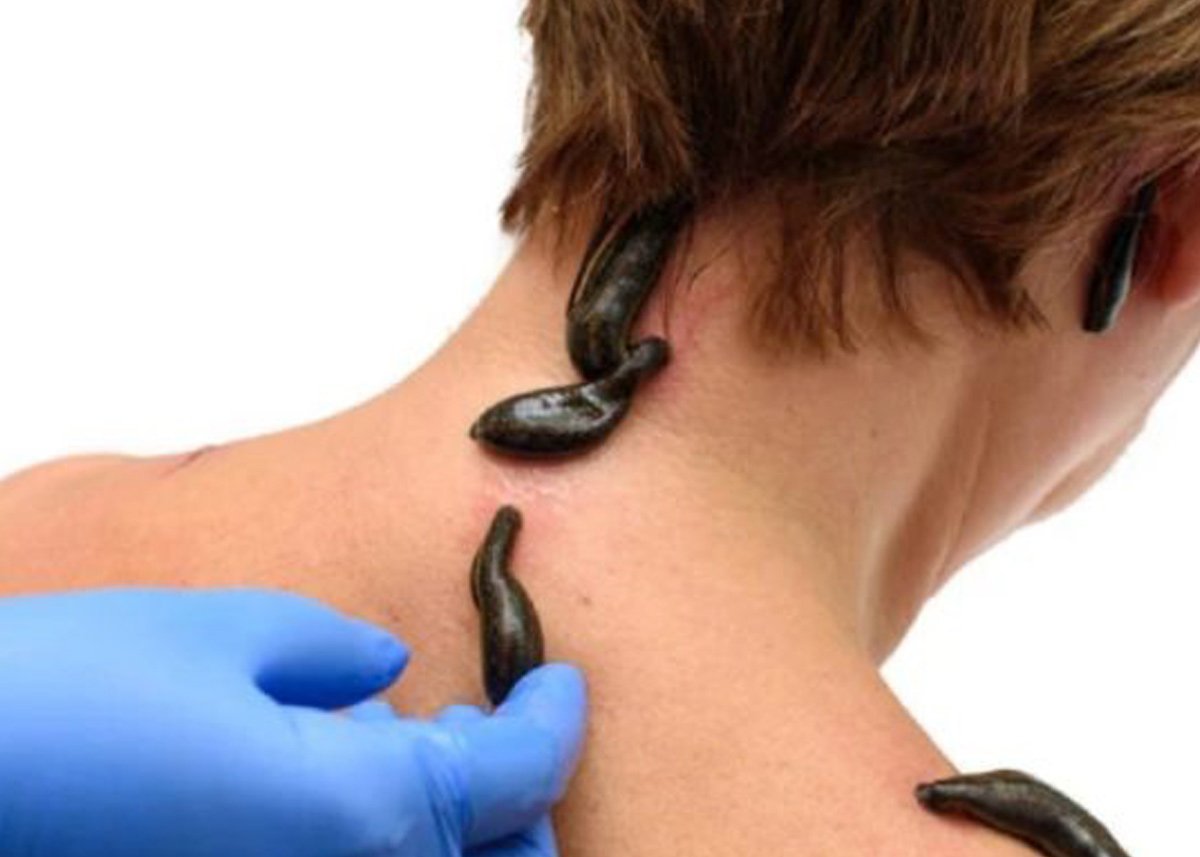 Hirudoterapi (Sülük)