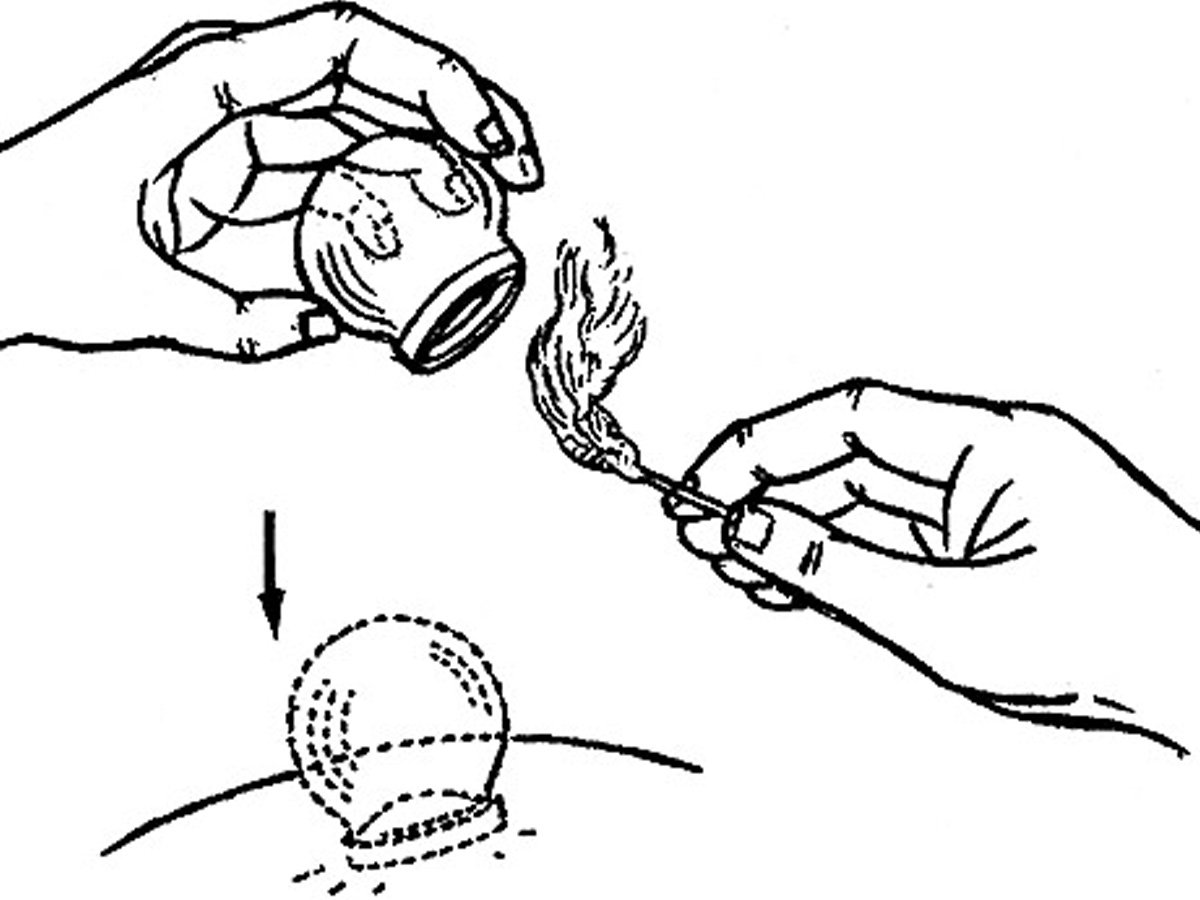 Ateşli kupa terapisi faydaları