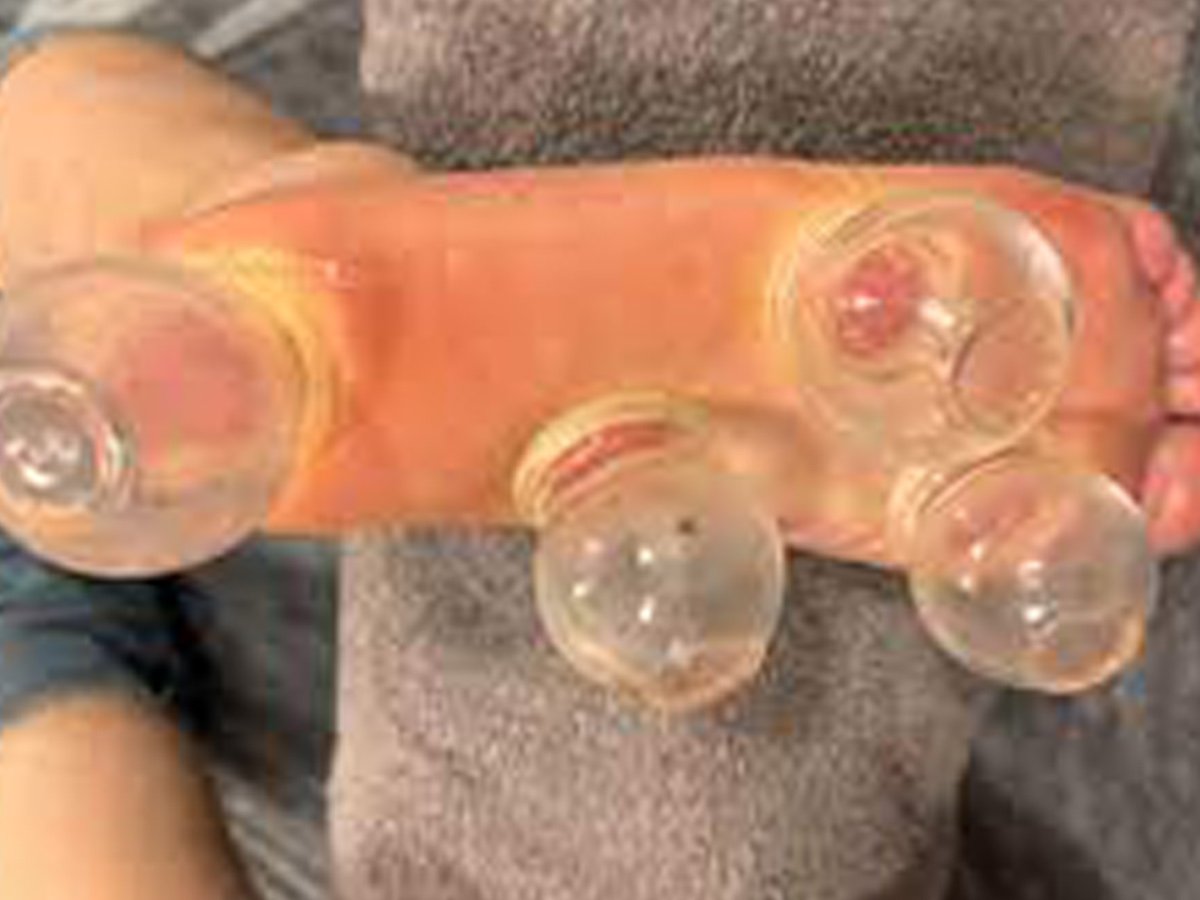 Ateşli kupa terapisi faydaları