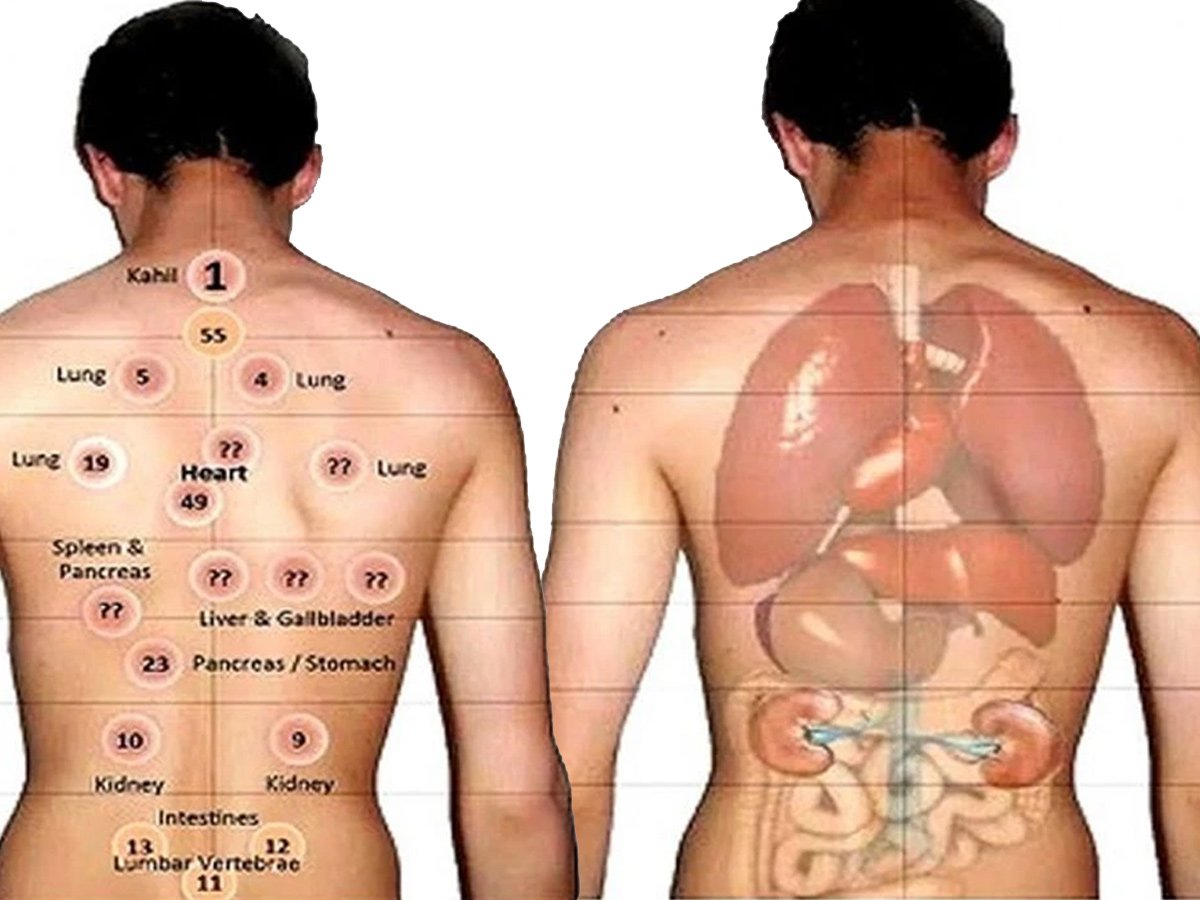 Hacamat (kupa terapisi)