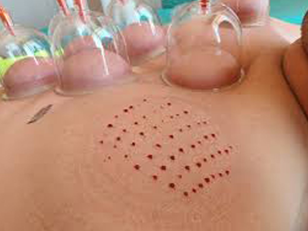 Hacamat (kupa terapisi)