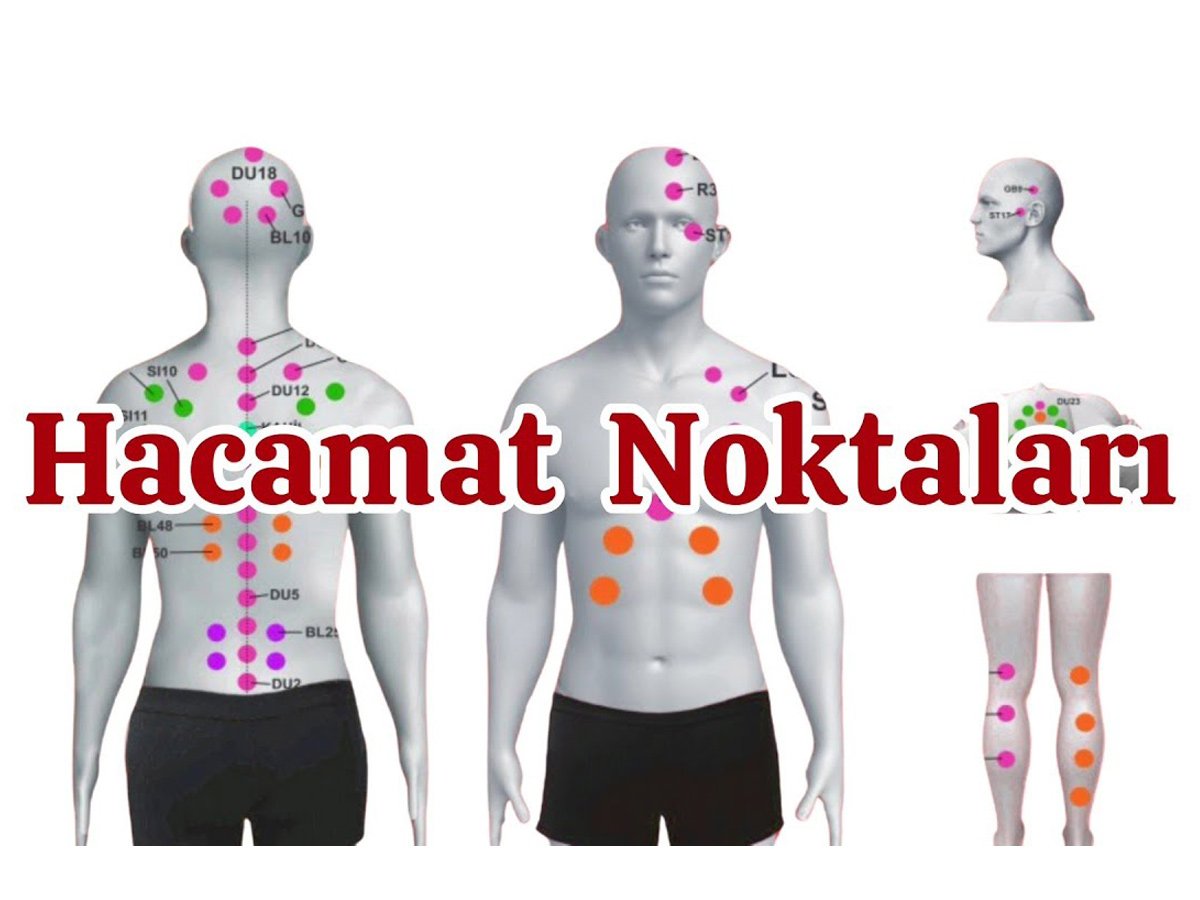 Hacamat (kupa terapisi)