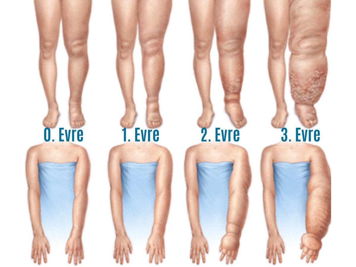 Lenfödem hastalarına uygulanan lenf drenaj masajı