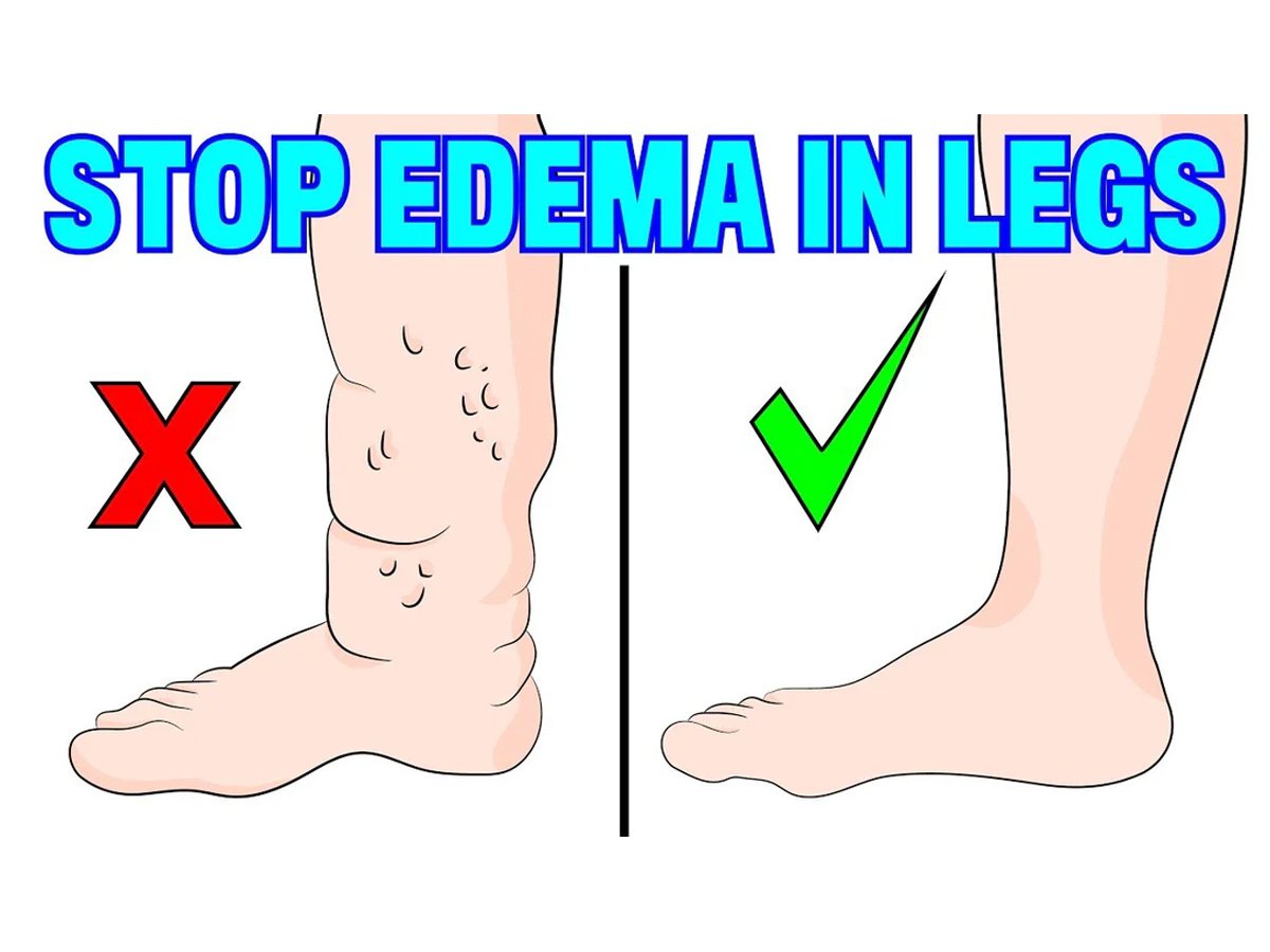 Lenfödem hastalarına uygulanan lenf drenaj masajı