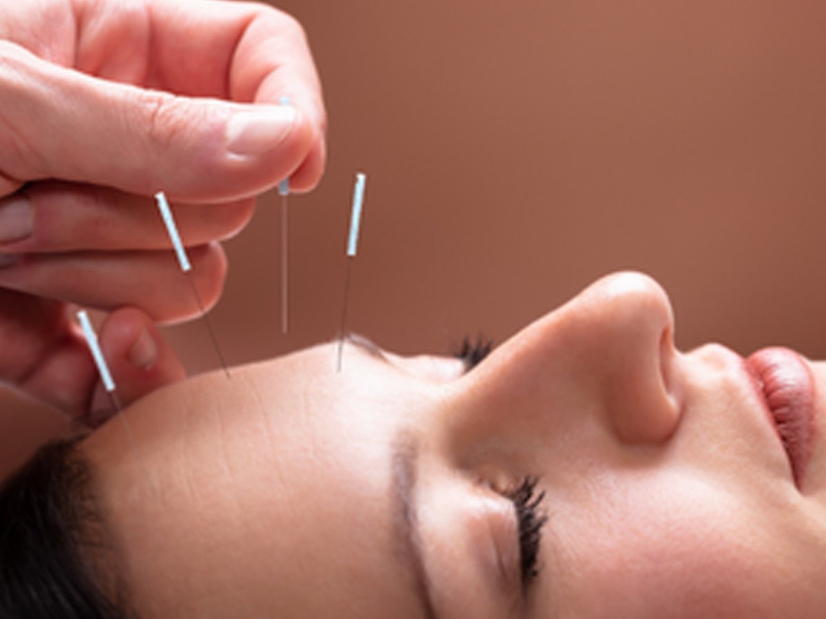 YNSA Kafa Akupunkturunun Başlıca Faydaları