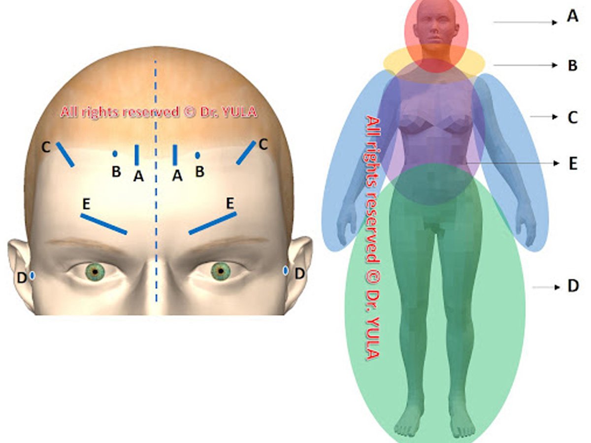 YNSA Kafa Akupunkturunun Başlıca Faydaları