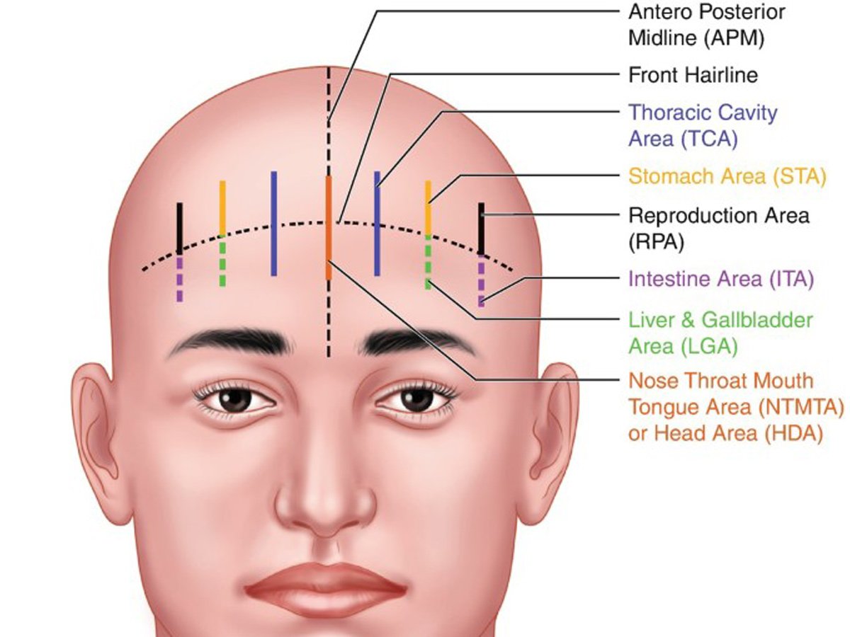 YNSA Kafa Akupunkturunun Başlıca Faydaları