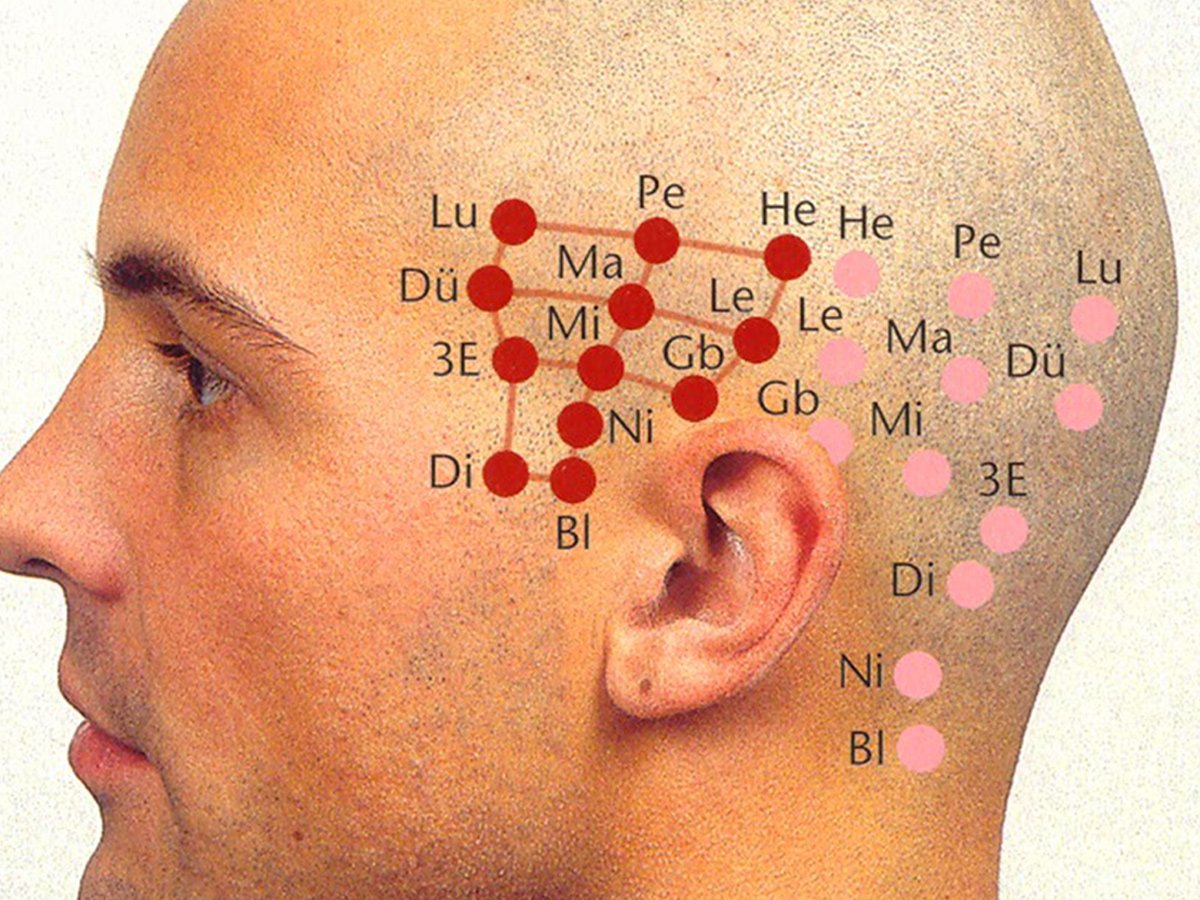 YNSA Kafa Akupunkturunun Başlıca Faydaları