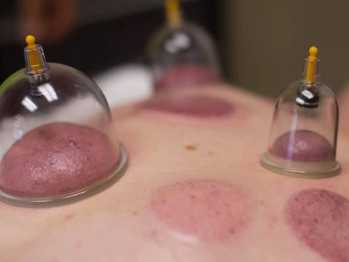 Hacamat (kupa terapisi)