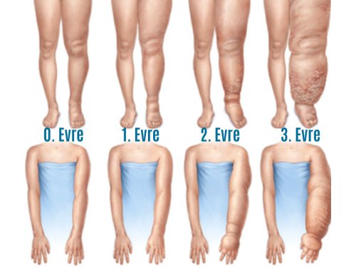 Lenfödem hastalarına uygulanan lenf drenaj masajı